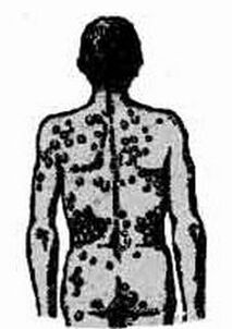 Schematic of the possibility of infection