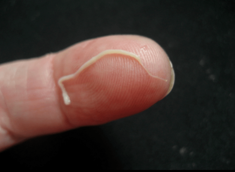 roundworm parasites of the human body